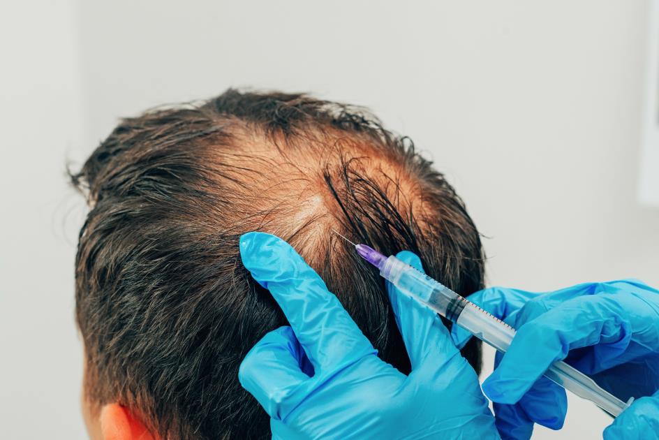 Homem com queda de cabelo hereditária tratado com PRP (plasma rico em plaquetas) na cabeça para estimular o crescimento do cabelo