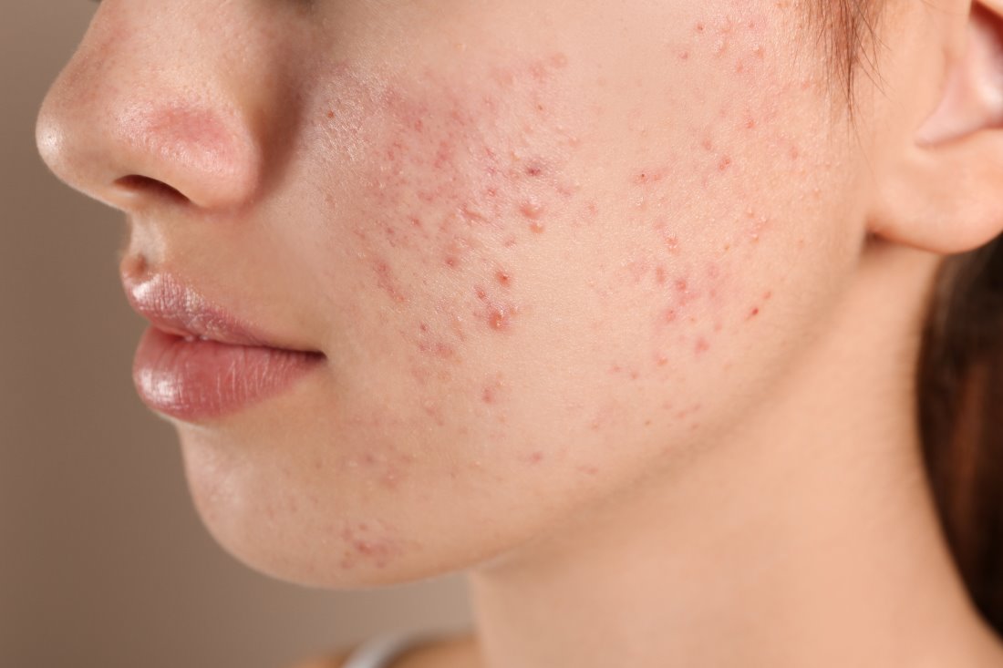 Mulher jovem com acne nas bochechas