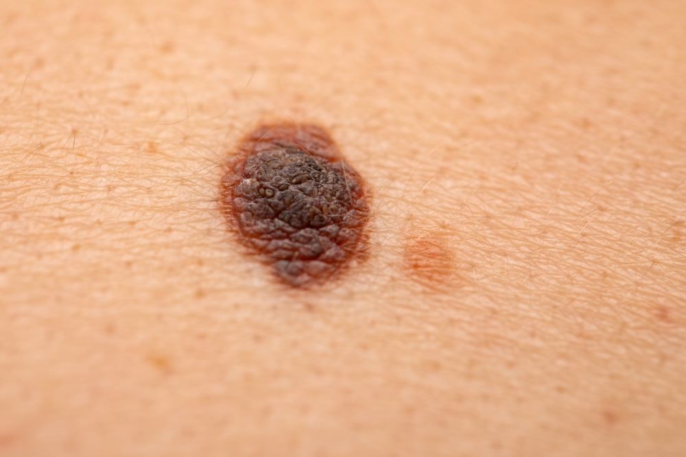 Vista em grande plano de um melanoma no braço