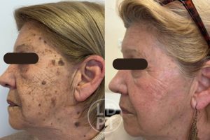 Remoção de manchas pigmentares e rejuvenescimento da pele em uma paciente por meio de laserterapia