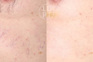 Remoção de vasos visíveis num paciente através de terapia a laser